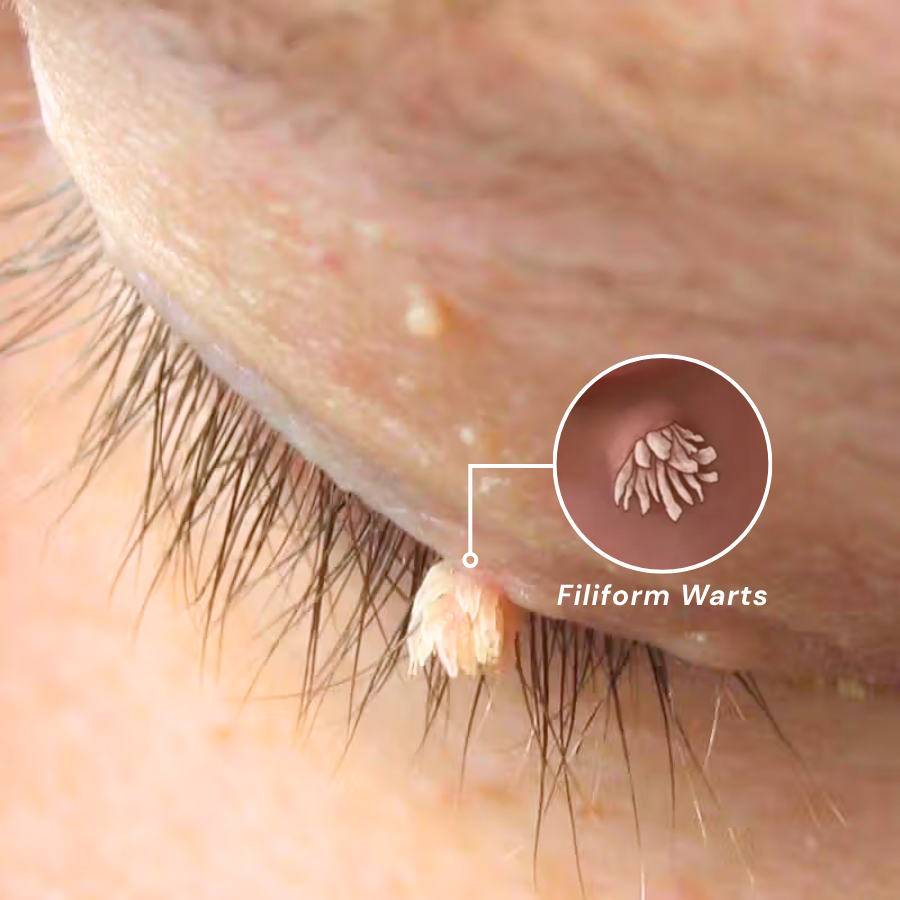 Fivfivgo® HPV Facial Filiform Warts Removal Cream 18 250717 Fivfivgo HPV Facial Filiform Warts Removal Cream Img3